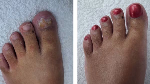 nagelreparatie