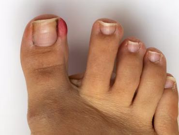 Ingegroeide nagels