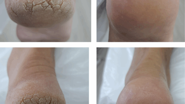 Preventieve voetzorg