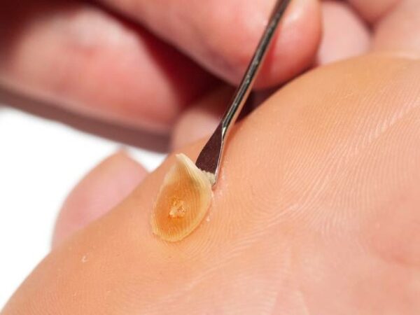 Likdoorn verwijderen 