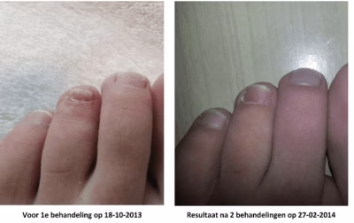 Laser behandelingen