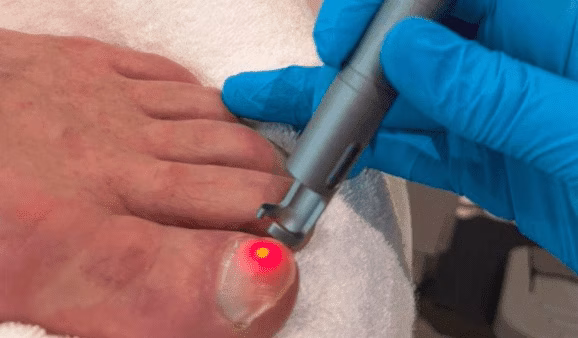 Laser behandelingen
